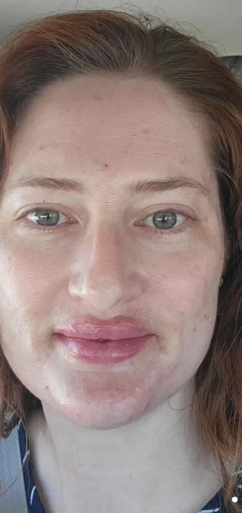 Before: BBL photofacial, first treatment, sun damage at Vero Beach Medical Spa