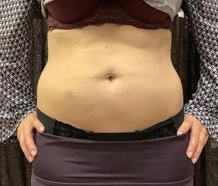 Before: EmSculpt Neo, abdomen at Vero Beach Medical Spa