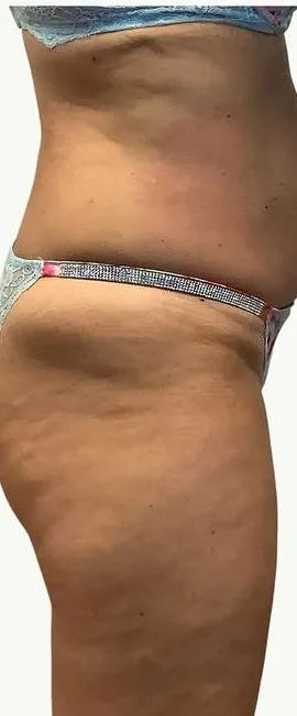 Before: EmSculpt Neo, abdomen and buttocks, side view at Vero Beach Medical Spa