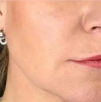 After: AquaGold facial at Vero Beach Medical Spa