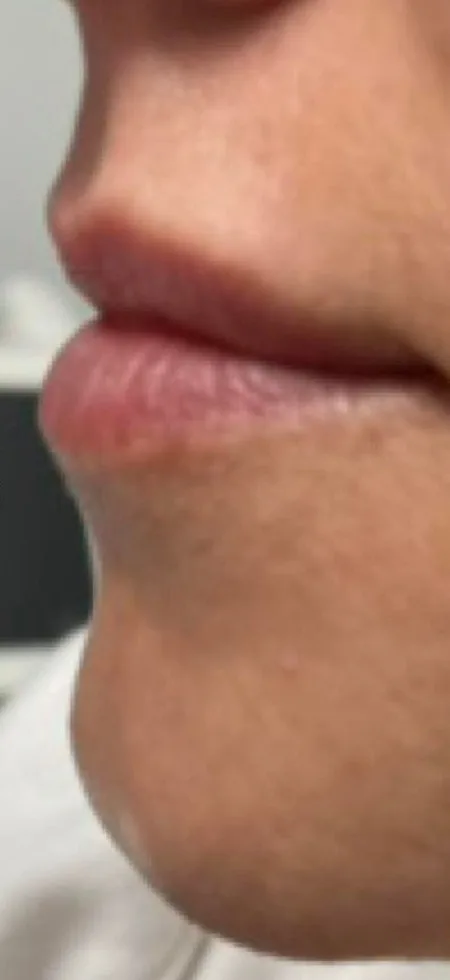 Before: Lip filler, profile at Vero Beach Medical Spa