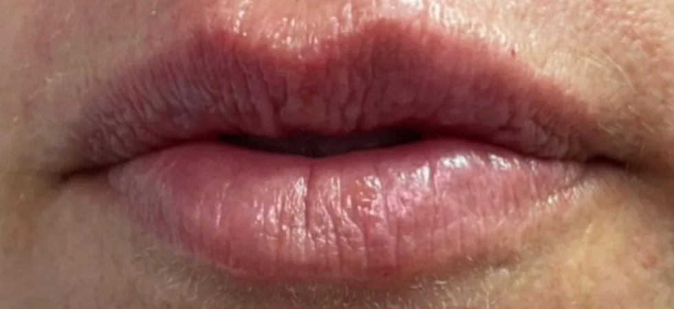 After: Lip filler, lines and definition at Vero Beach Medical Spa