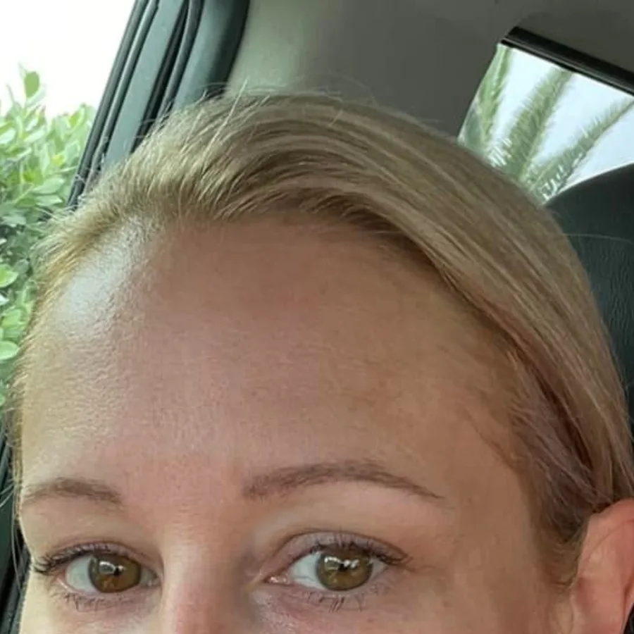 2 days later: Dr. Million's own Morpheus8 face + neck treatment, downtime at Vero Beach Medical Spa