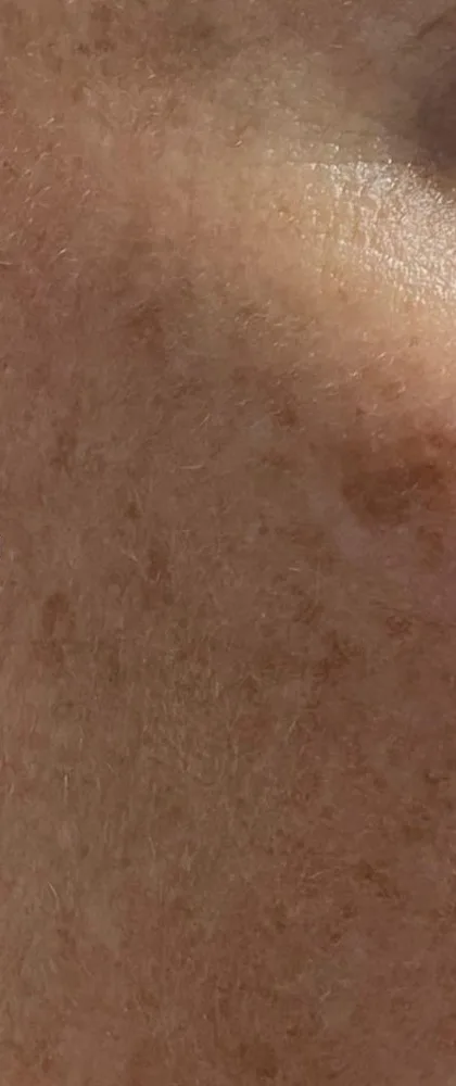 Before: MOXI + BBL, cheek at Vero Beach Medical Spa