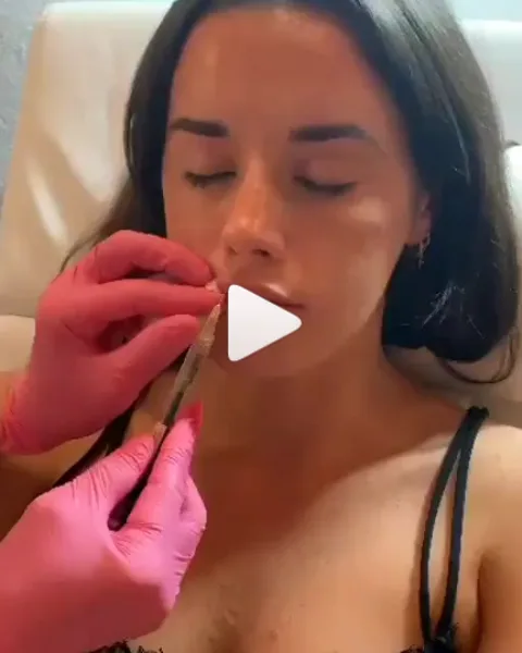 Lip filler injection